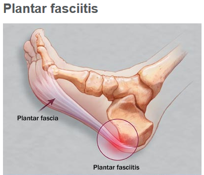 Rheumatoid Arthritis of the Foot and Ankle - OrthoInfo - AAOS